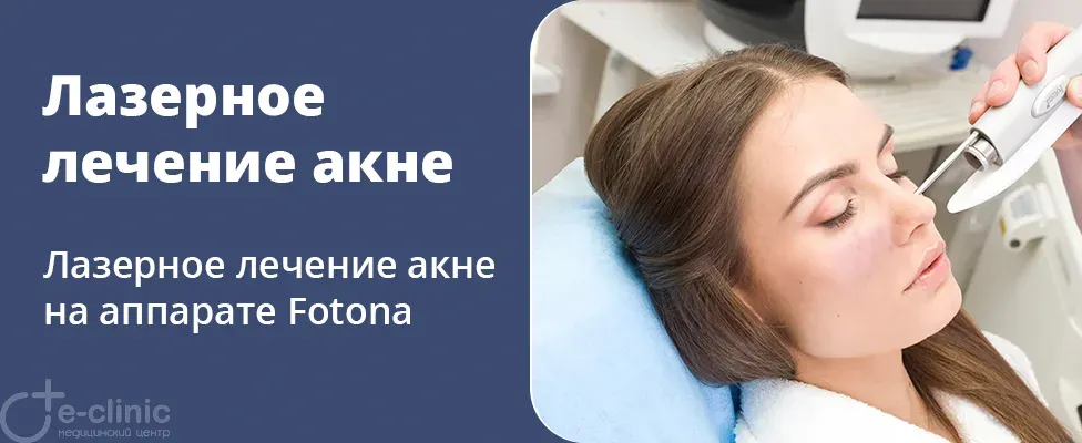 Лазерное лечение акне на аппарате Fotona