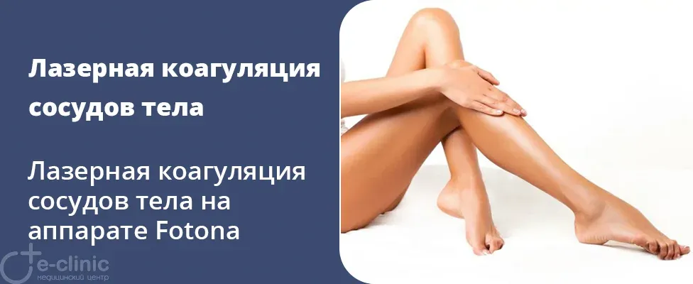 Лазерная коагуляция сосудов на аппарате Fotona