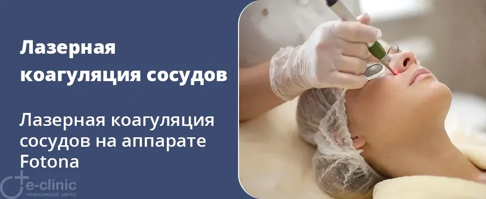 Лазерная коагуляция сосудов лица на аппарате Fotona
