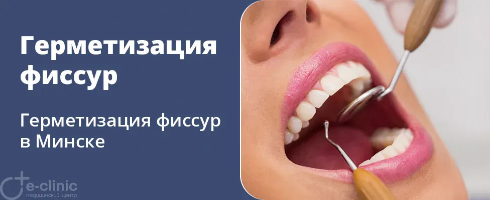 Герметизация фиссур