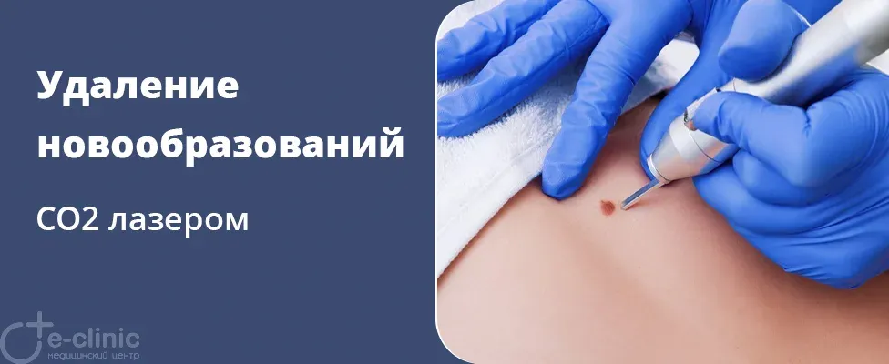 Лазерное СО2 удаление доброкачественных новообразований кожи (родинки, папилломы, кератомы и др.)