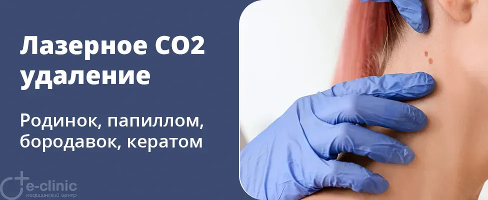 Удаление доброкачественных новообразований: родинок, папиллом, бородавок