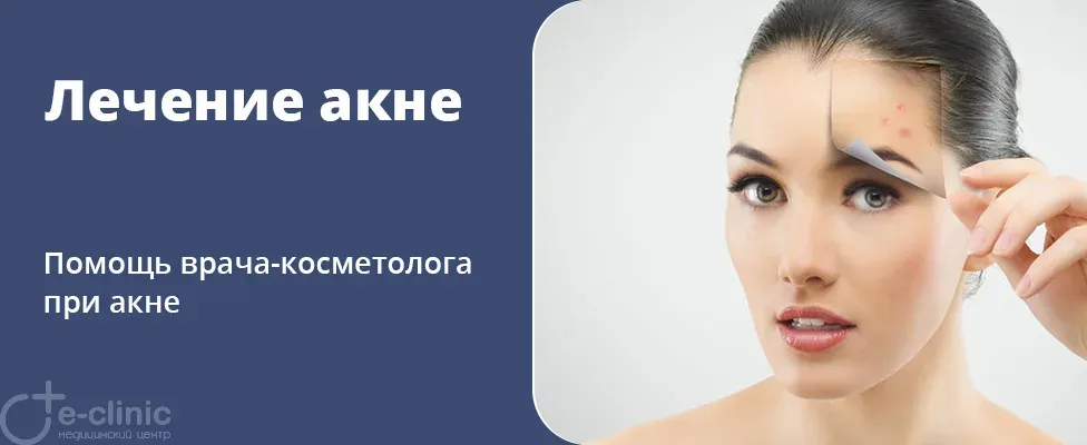 Лечение акне