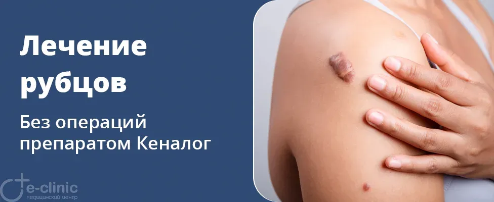 Лечение келоидных рубцов препаратом Кеналог